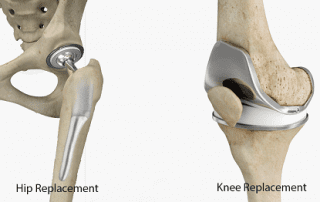 Hip and Knee Replacement