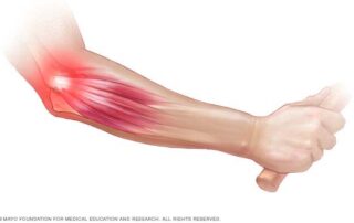 lateral epicondylitis