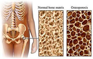 Osteoporosis